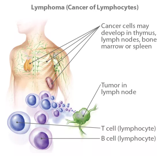 Blood cancers